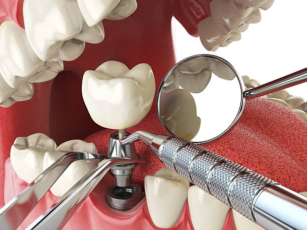Best Emergency Tooth Extraction in Marksville, LA